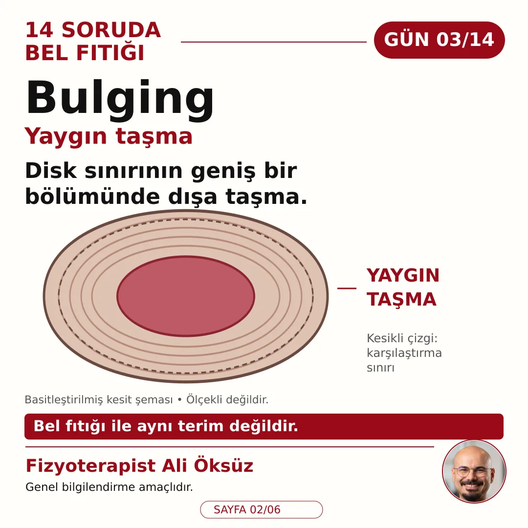Bulging yaygın taşma: disk sınırının geniş bir bölümünde dışa taşma, bel fıtığı ile aynı terim değildir