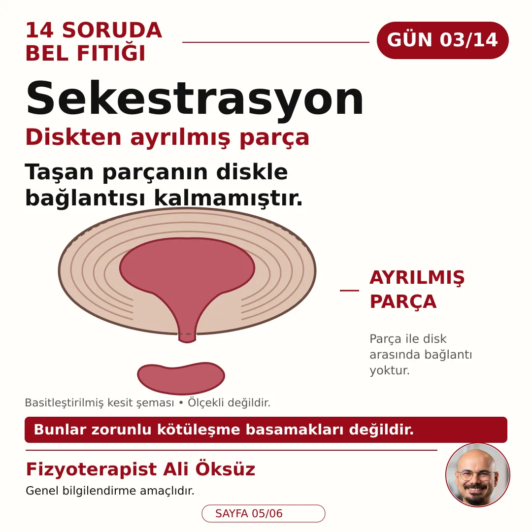 Sekestrasyon diskten ayrılmış parça: taşan parçanın diskle bağlantısı kalmamıştır