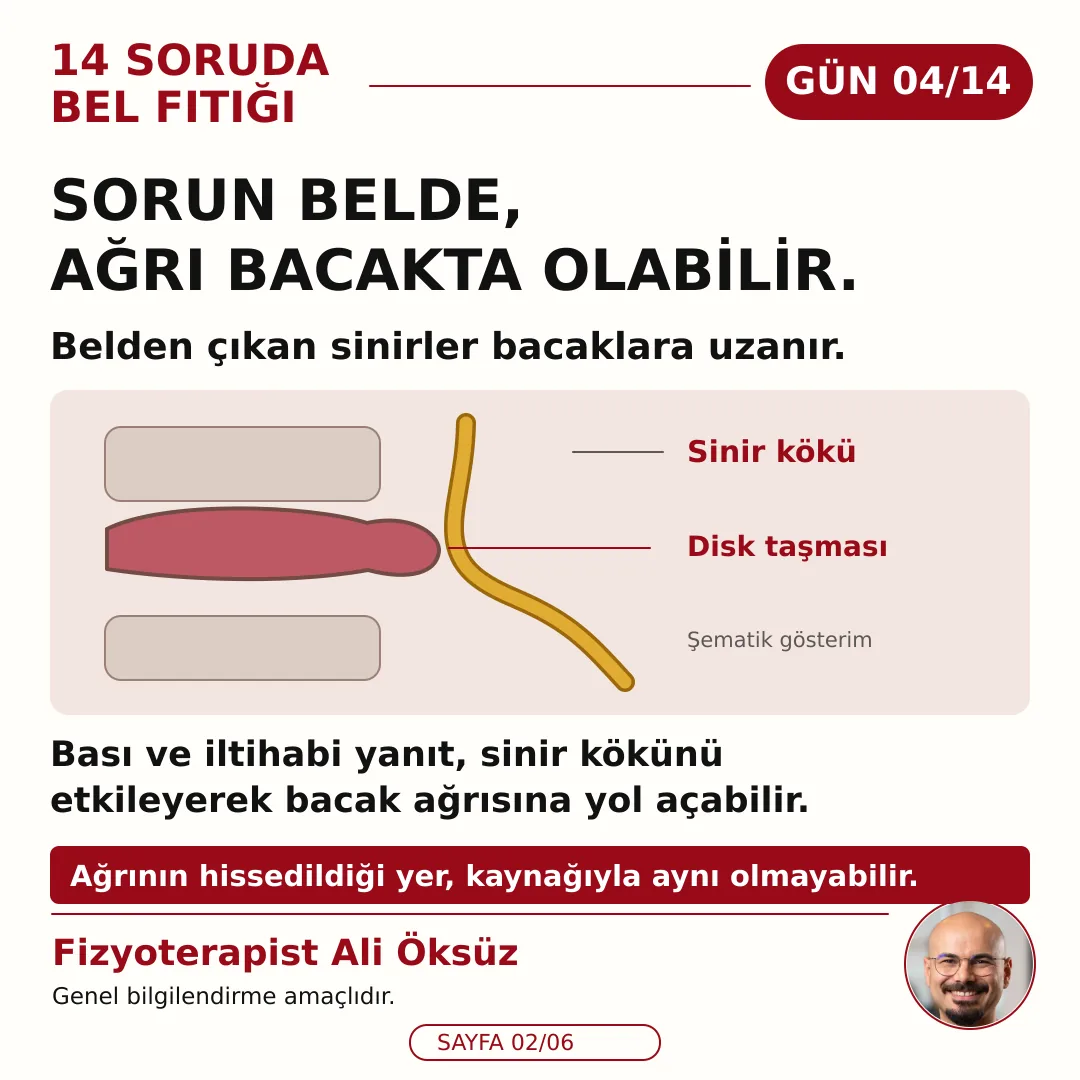 Sorun belde, ağrı bacakta olabilir: disk taşması sinir köküyle ilişkilendiğinde bacağa ağrı yayılabilir (şematik gösterim)