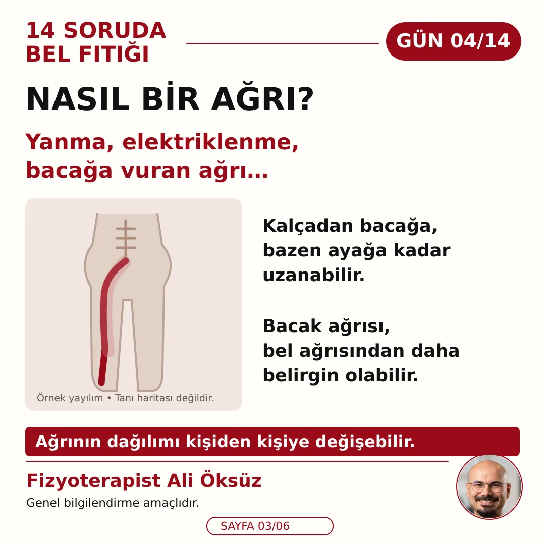 Nasıl bir ağrı? Yanma, elektriklenme ve kalçadan bacağa uzanan ağrı, örnek yayılım şeması