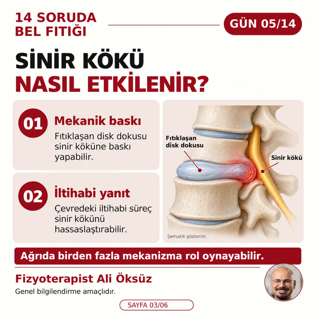 Sinir kökü nasıl etkilenir? Fıtıklaşan disk dokusunun mekanik baskısı ve çevredeki iltihabi yanıt (şematik gösterim)