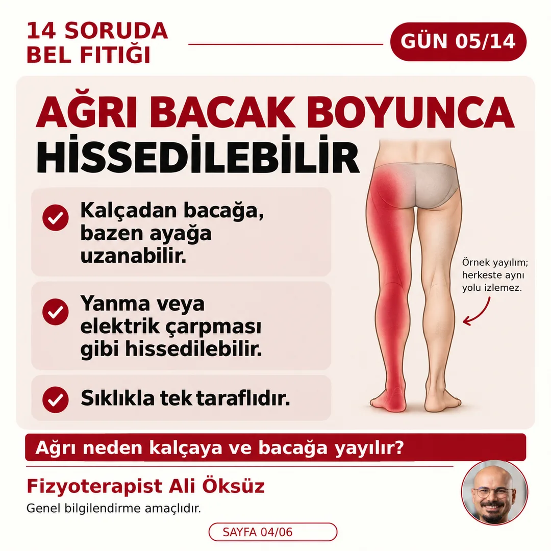 Bel fıtığında ağrı kalçadan bacağa, bazen ayağa uzanabilir; yanma veya elektrik çarpması gibi hissedilebilir, sıklıkla tek taraflıdır (örnek yayılım)